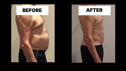 What Symptoms Can Diastasis Recti Cause in Men? Weak Core, Back Pain and Poor Posture Palmers Green